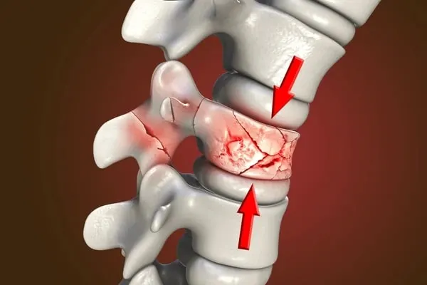 Fracture Management